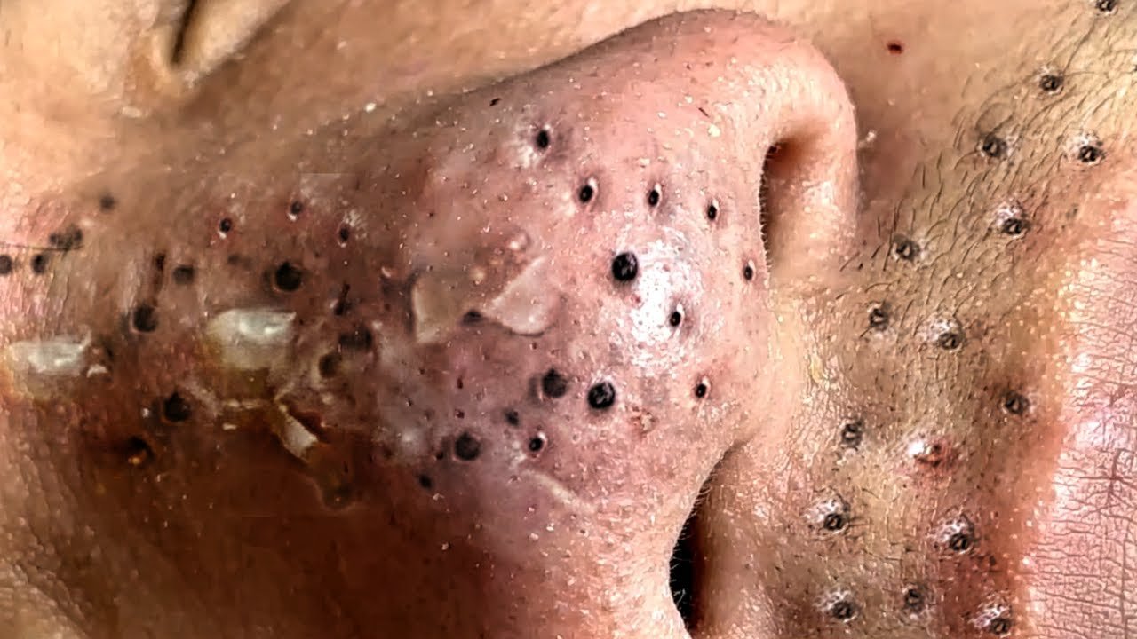 Blackhead Removal 9
